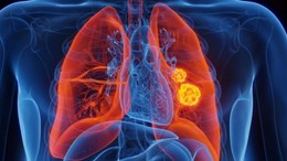 Akciğer kanserinde devrim: İmmünoterapiyle yaşam süresi uzuyor