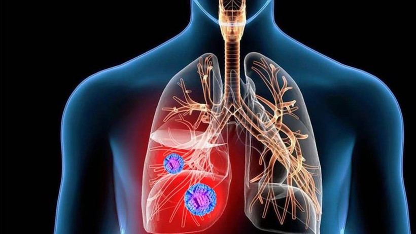 İmmünoterapi: Akciğer kanserine yeni umut