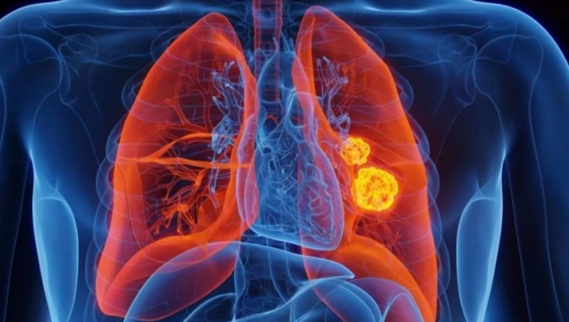 Akciğer kanserinde devrim: İmmünoterapiyle yaşam süresi uzuyor